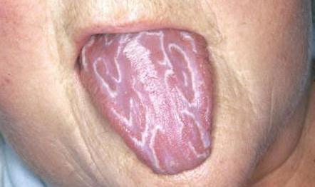Geographic Tongue Pictures 2