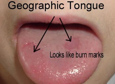 geographic tongue burns