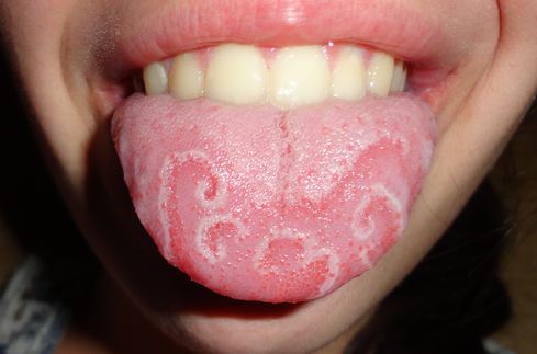 geographic tongue images