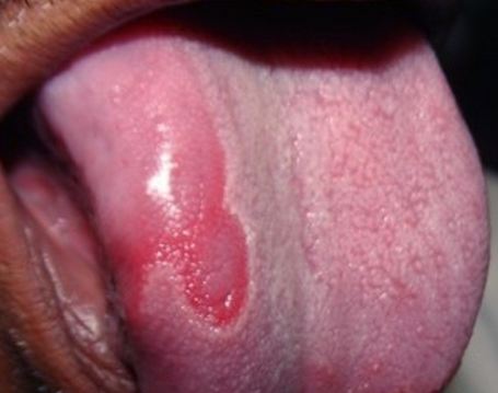 geographic tongue pictures