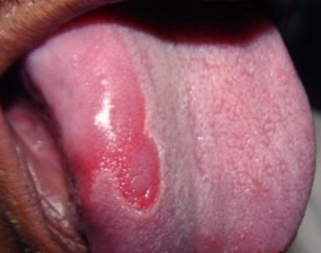 geographic tongue pictures