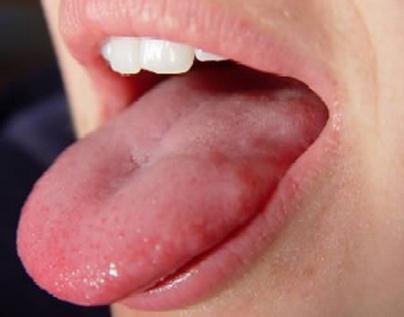 red inflamed taste buds