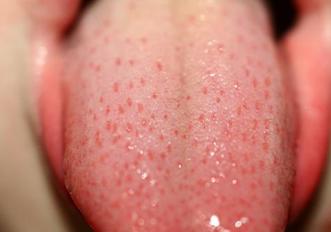 taste buds inflamed picture
