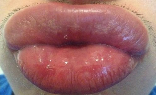 Fordyce Spots on Lips, Causes Cure, White Bumps, Cream ...