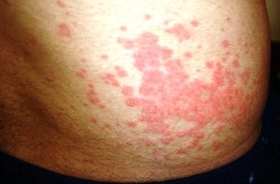 Erythematous-Maculopapular-Rash-image-min