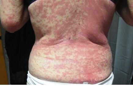 maculopapular rash on back of abdomen-min