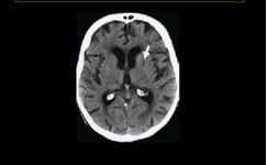 CT Image of lacunar infarct