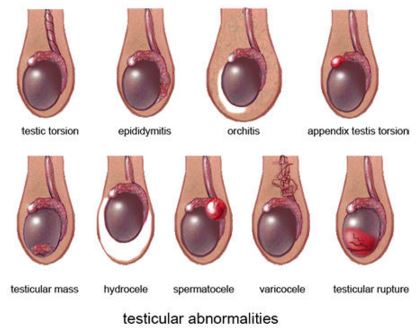 Cause of testicular pain