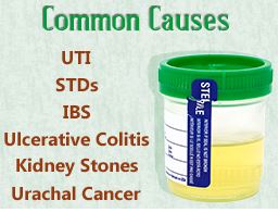 Causes of mucous in urine