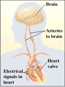 Causes of vasovagal syncope