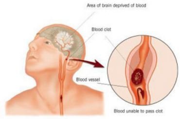 Description of lacunar infarct