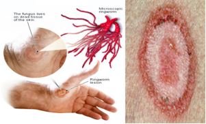 ringworm treatment development