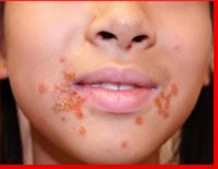 Infantigo turns to yellow- brown pimples