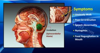 Location and Symptoms of Spinocerebellar Ataxia