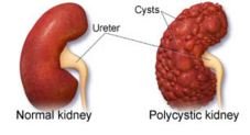 Polycystic kidney disease