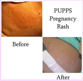Puppp rash condition before and after pregnancy