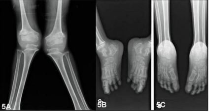 Rotentogenographic description of Morquio syndrome