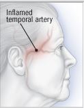 Inflamation of temporal artery