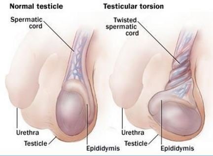 Testicular torsion