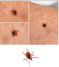 Bug Bites that Blister