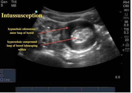 Ultrasonography of Intussuception
