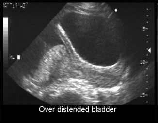 Ultrasonography of distended bladder