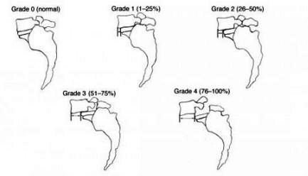 anterolisthesis grading