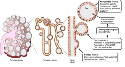 cause of polycystic kidney