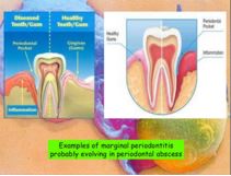 overview of periodental abscess