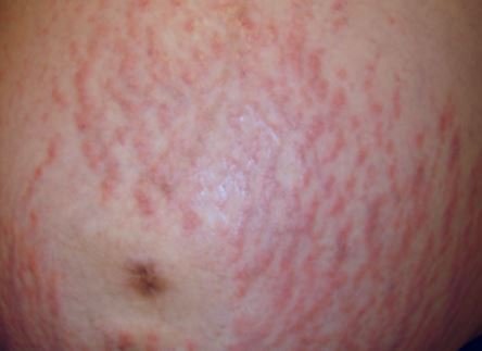 PUPPS Rash: Pruritic Urticarial Papules And Plaques Of ...