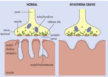 Changes of neuromuscular junction in Mysthenia Gravis