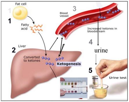 Ketones in urine - ketogenesis