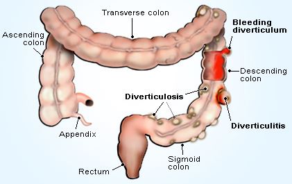 Large intestine with verticulitis
