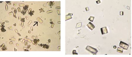 Uric acid crystals in urine