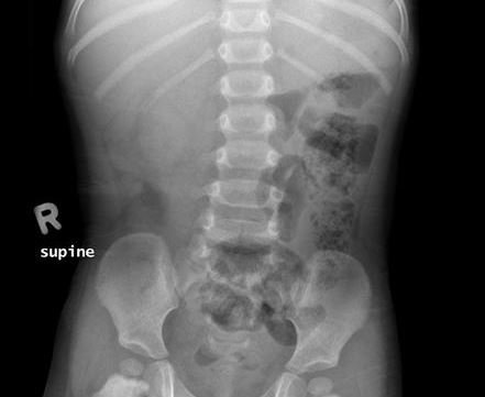 Intussusception xray