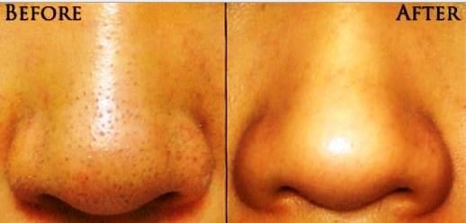 blackheads before and after photo