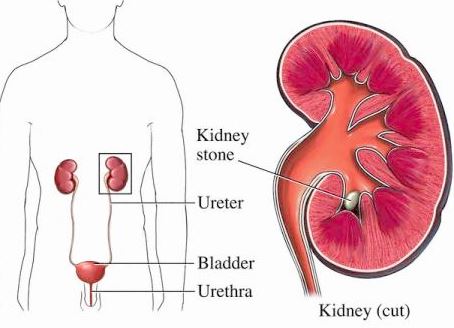 urosepsis kidney anatomy stone
