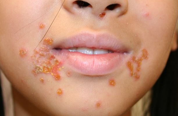 impetigo pic