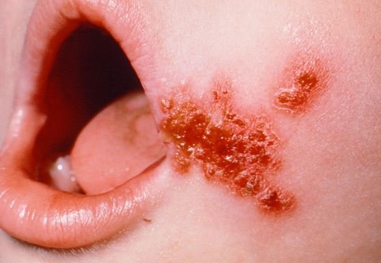 impetigo pictures 3