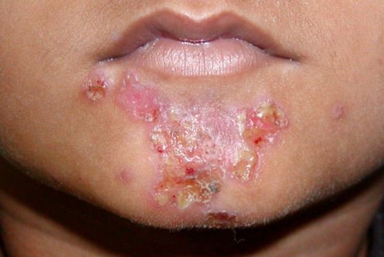 impetigo under lower lip