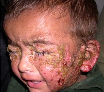 impetigo in child