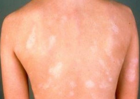 Pityriasis Alba image