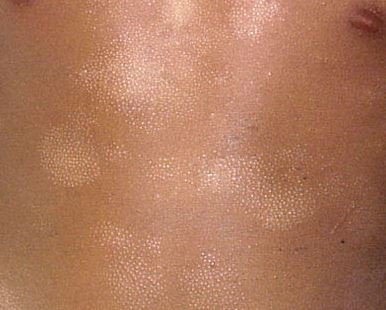 Pityriasis Alba pic