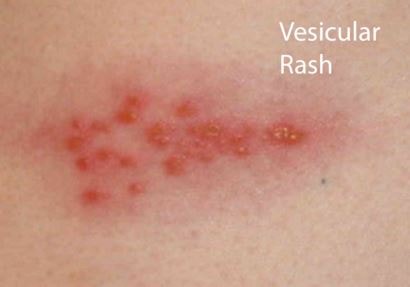 shingles rash
