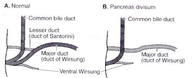 pancreas-divisum