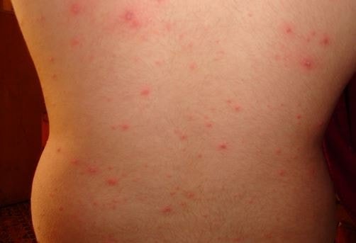 Maculopapular Rash 2