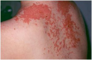 Maculopapular Rash Pictures Causes Treatment Definition Signs