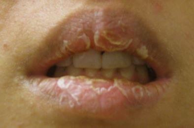 Crusty Lips Pictures 7