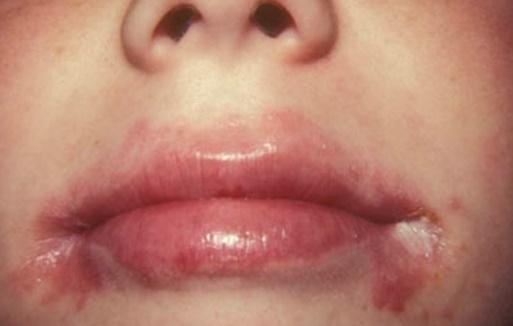 crusty-lips-how-to-get-rid-symptoms-causes-remedies-pictures