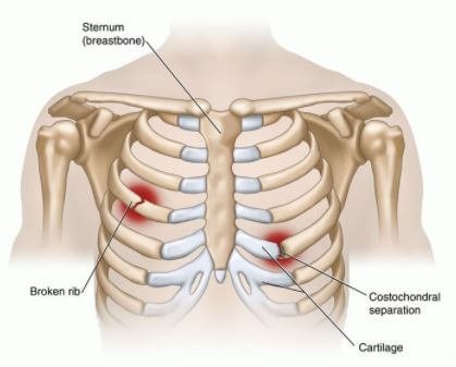 Dislocated RIB